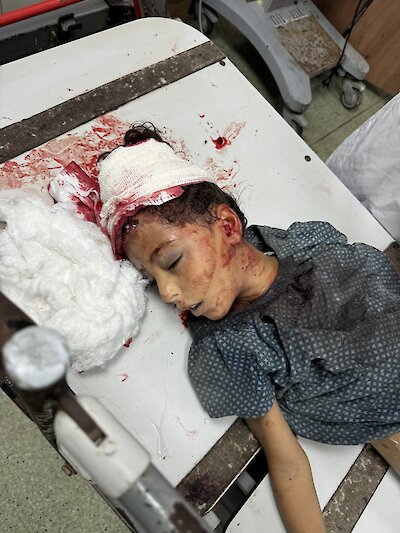 Dziewczynka w wieku 6 lub 7 lat z raną postrzałową głowy.Zdjęcie: Mimi Syed