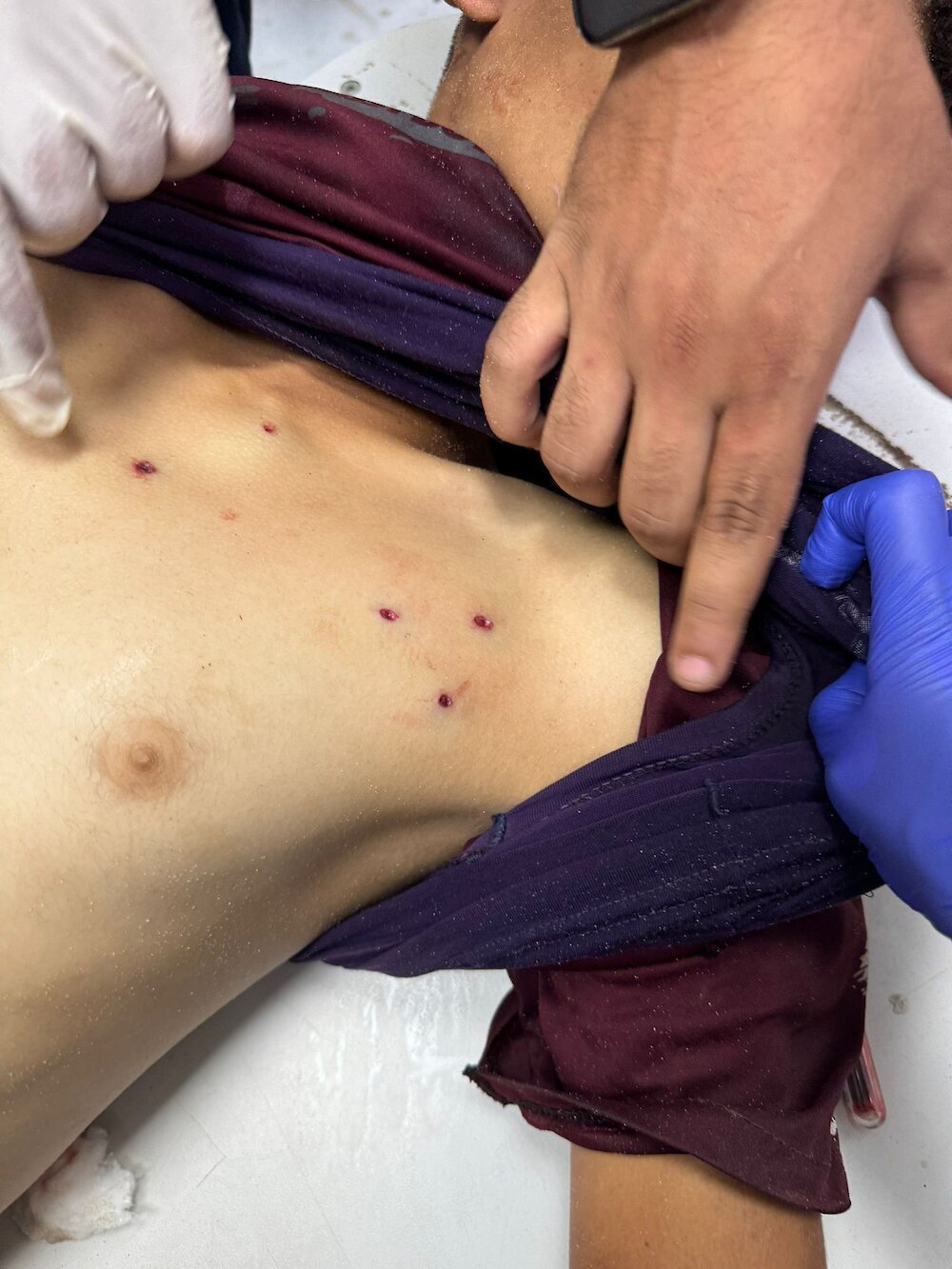 Zmarły chłopiec z niewielkimi ranami, według lekarza został trafiony metalowymi odłamkami.Zdjęcie: Mimi Syed
